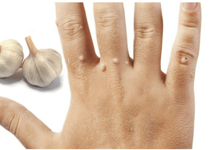 Top 5 cách trị mụn cóc cho nam hiệu quả
