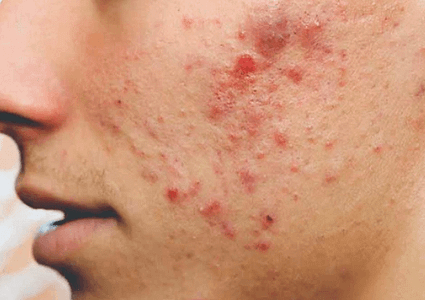 Nguyên nhân và cách trị mụn trứng cá ở nam giới